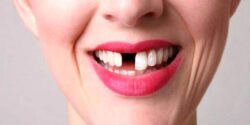 تعبیر خواب افتادن دندان نیش بالا بدون خونریزی + افتادن دندان نیش امام صادق
