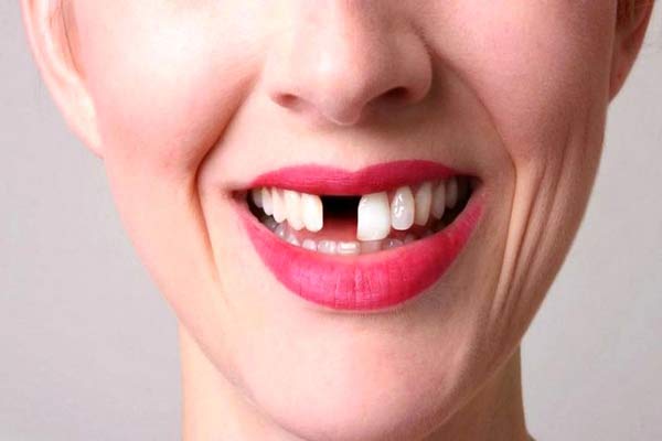 تعبیر خواب افتادن دندان نیش بالا بدون خونریزی + افتادن دندان نیش امام صادق