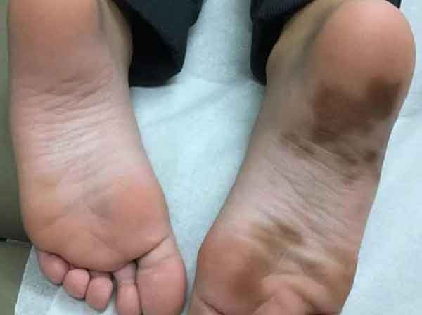 تعبیر خواب کبودی پا امام صادق + کبودی ساق پا و راق پا و مچ پا