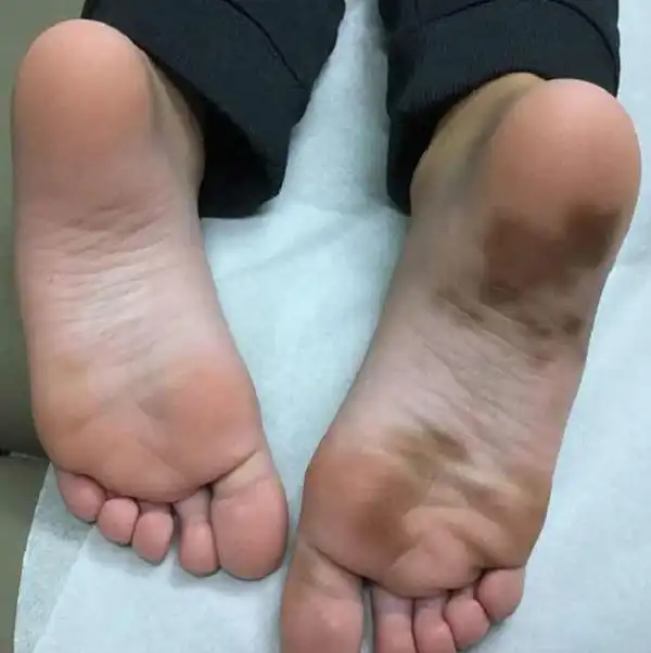 تعبیر خواب زخم پای مرده + زخم روی بدن مرده و زخم بستر مرده