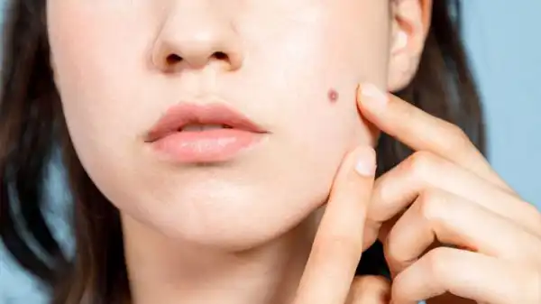تعبیر خواب چرک جوش + جوش چرکی امام صادق و جوش صورت حضرت یوسف