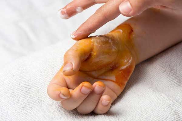 تعبیر خواب سوختن با آب جوش + امام صادق و سوختن دست و صورت و تاول زدن