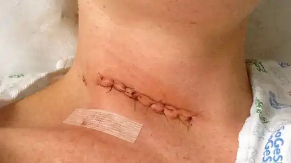 تعبیر خواب زخم در گردن + امام صادق و زخم دست و صورت بدون خون و زخم سر مرده
