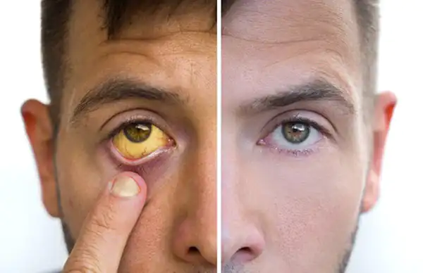 تعبیر خواب چشم زرد + عفونت چشم امام صادق و تغییر رنگ چشم به خاکستری