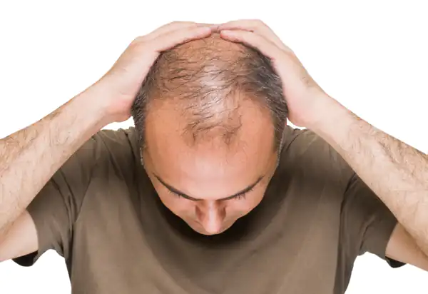 تعبیر خواب دیدن مرد کچل + مرد کچل برای دختر مجرد و کچل شدن مرد متاهل