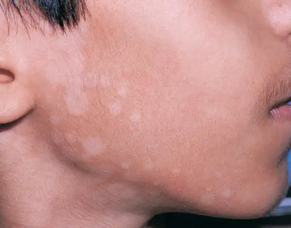 تعبیر خواب قارچ پوستی + قارچ روی دست و بیماری پوستی سر