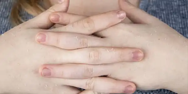 تعبیر خواب کپک زدن بدن + کپک زدن دیوار خانه و لباس و کپک زدن موی سر