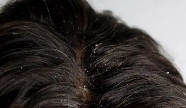 تعبیر خواب کپک زدن مو + کپک زدن بدن و میوه و لباس و دیوار خانه و ترشی