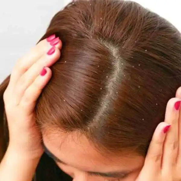تعبیر خواب کپک زدن سر + خوردن نان کپک زده حضرت یوسف و کپک زدن بدن