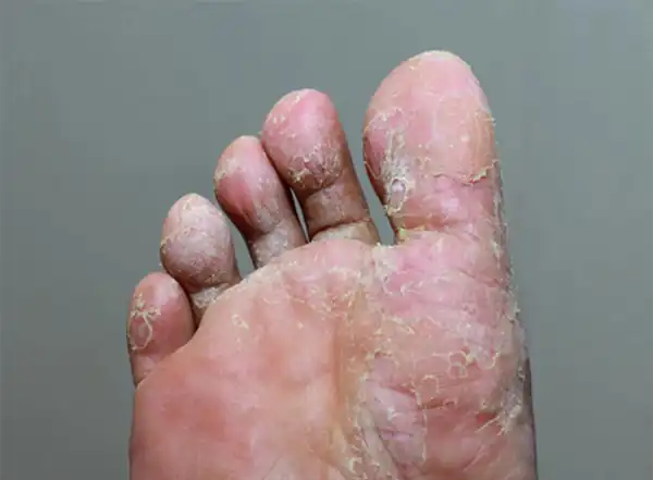 تعبیر خواب پوست انداختن پاشنه پا + کندن پوست مرده پا و کف پا امام صادق