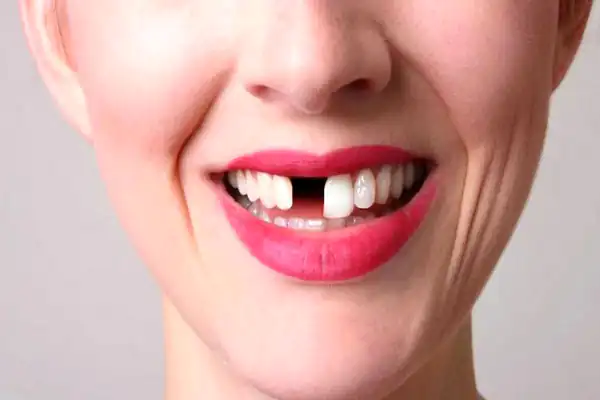تعبیر خواب افتادن دندان جلو برای زن متاهل + با درد و و ناراحتی و از دست دادن چیزی