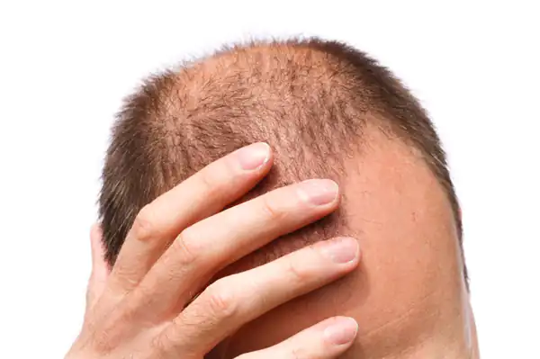 تعبیر خواب ریزش مو کچل شدن + کچل شدن و ناراحتی و کچل شدن ناگهانی
