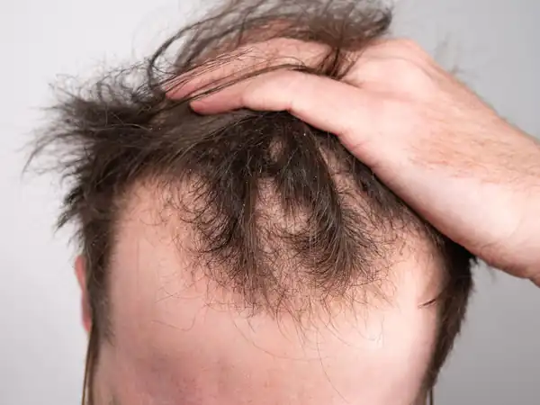 تعبیر خواب ریزش مو چیست + ریزش مو ابرو و ریزش مو ریش و ریزش مو و ناراحتی
