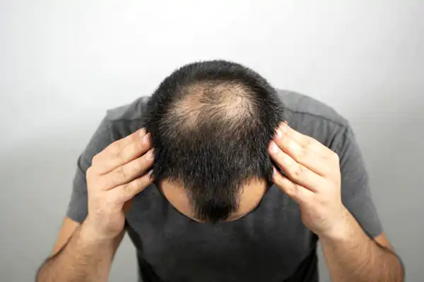 تعبیر خواب ریزش موی شدید + ریزش موی شدید و کچلی و ریزش موی شدید و گریه کردن