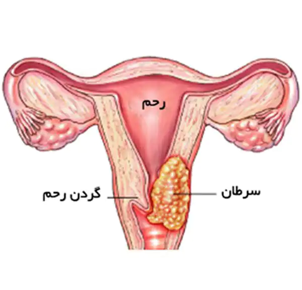 تعبیر خواب سرطان رحم + ترس از سرطان رحم و سرطان رحم و زن