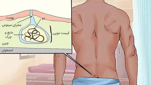 تعبیر خواب غده در کمر + برای زن متاهل و باردار و دختر مجرد و از دید مولف